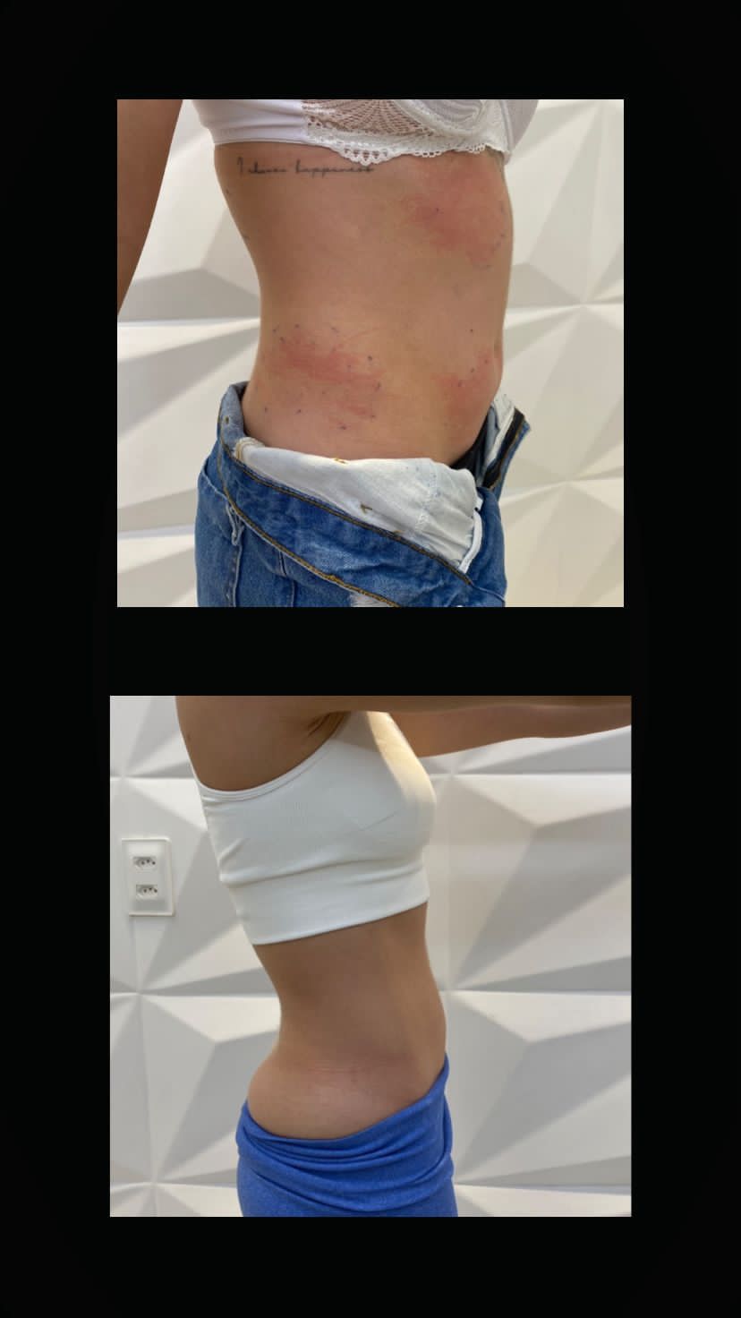 Registro de antes e depois com duas fotografias laterais do tronco, organizadas uma acima da outra.